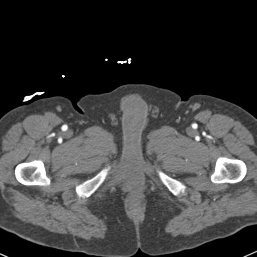 File:Aortic intramural hematoma (Radiopaedia 31139-31838 B 183).jpg