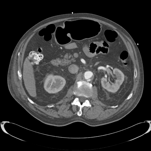 Aortic intramural hematoma (Radiopaedia 34260-35540 B 50).png
