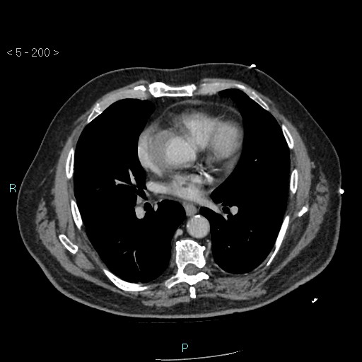 Aortic intramural hematoma (Radiopaedia 48463-53380 C 90).jpg