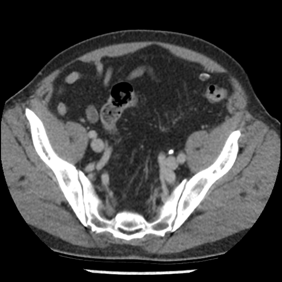 Aortic intramural hematoma (type B) (Radiopaedia 79323-92387 Axial C+ delayed 98).jpg