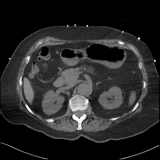 File:Aortic intramural hematoma with dissection and intramural blood pool (Radiopaedia 77373-89491 Axial non-contrast 107).jpg