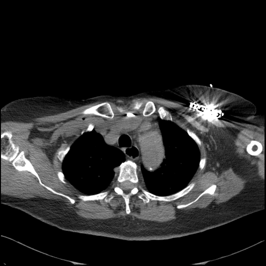 Aortic intramural hematoma with dissection and intramural blood pool (Radiopaedia 77373-89491 Axial non-contrast 23).jpg