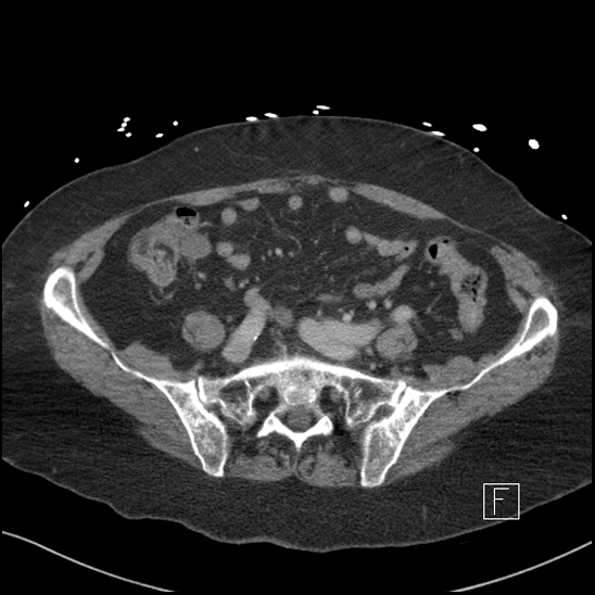 File:Aortic intramural hematoma with dissection and intramural blood pool (Radiopaedia 77373-89491 E 69).jpg
