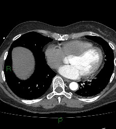 File:Aortic valve endocarditis (Radiopaedia 87209-103485 C 64).jpg