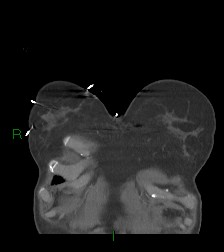 Aortic valve endocarditis (Radiopaedia 87209-103485 D 67).jpg