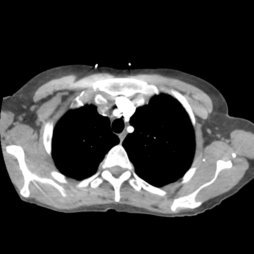 Aortic valve non-coronary cusp thrombus (Radiopaedia 55661-62189 B 10).png