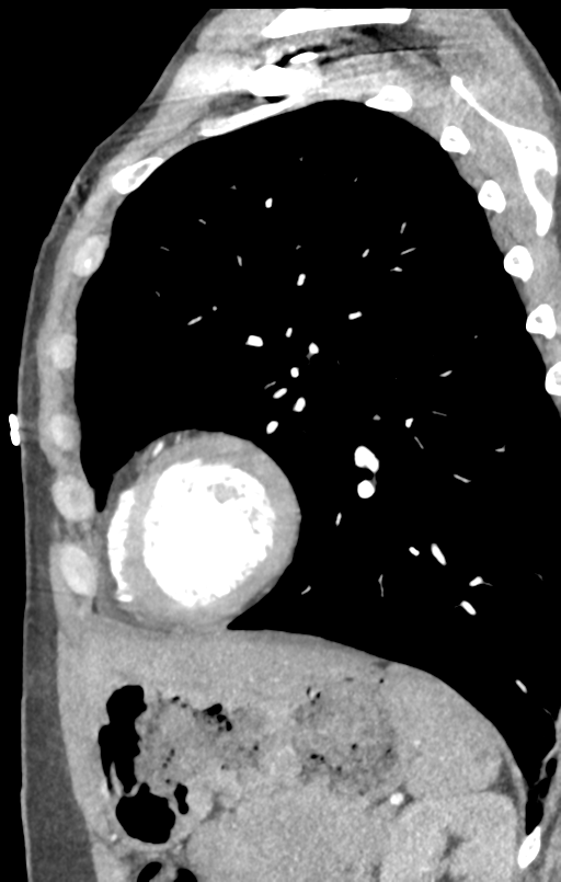 Aortic valve non-coronary cusp thrombus (Radiopaedia 55661-62189 C+ arterial phase 9).png