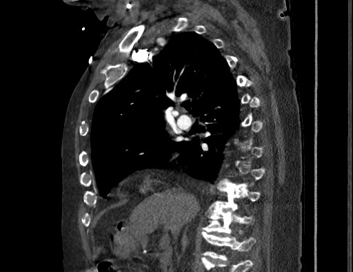 Aortoesophageal fistula with endovascular repair (Radiopaedia 73781-84592 Sagittal C+ CTPA 76).jpg