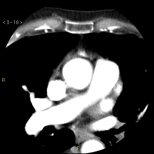 File:Aortoiliac occlusive disease (Radiopaedia 16828-16548 A 18).jpg