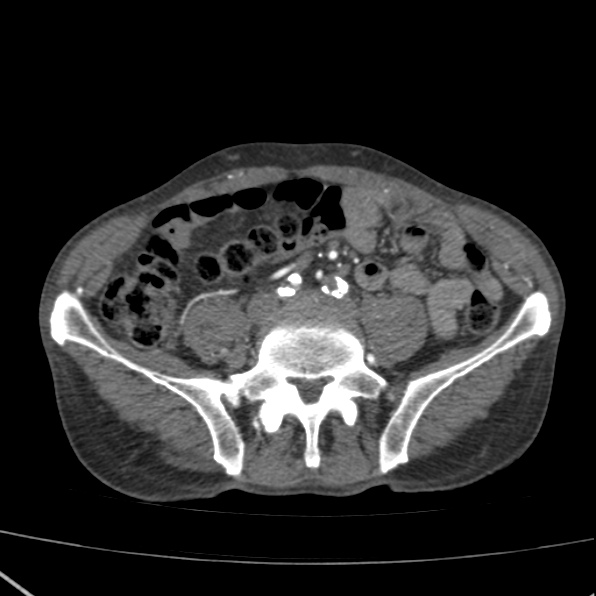 Aortoiliac occlusive disease (Radiopaedia 32134-33076 G 55).jpg