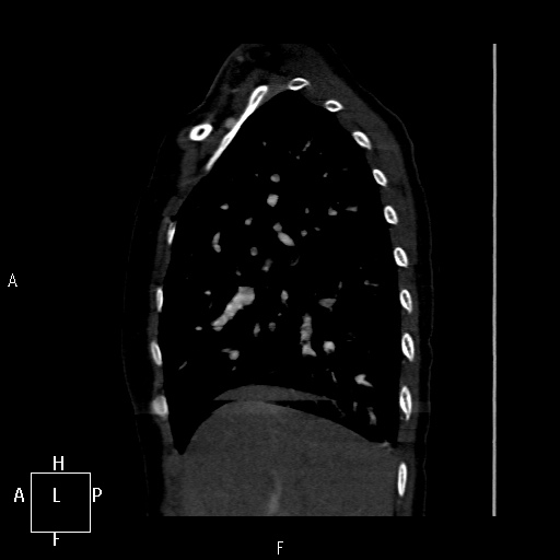 File:Aortopulmonary septal defect (Radiopaedia 41990-45013 Sagittal C+ CTPA 50).jpg