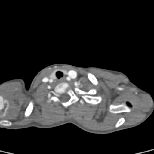 File:Aortopulmonary window, interrupted aortic arch and large PDA giving the descending aorta (Radiopaedia 35573-37074 B 2).jpg