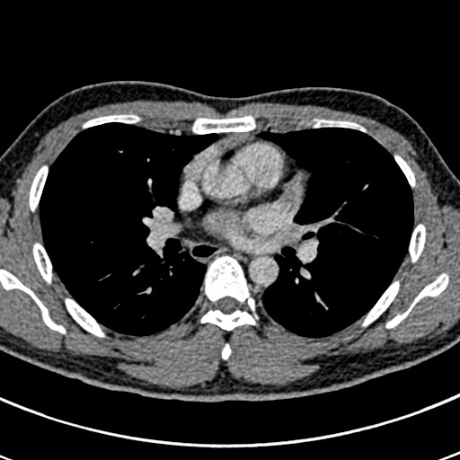 File:Apical lung mass mimic - neurogenic tumor (Radiopaedia 59918-67521 A 40).jpg