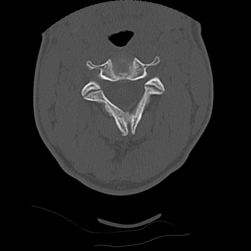File:Apical pneumothorax on cervical spine CT (Radiopaedia 45343-49368 Axial bone window 30).jpg