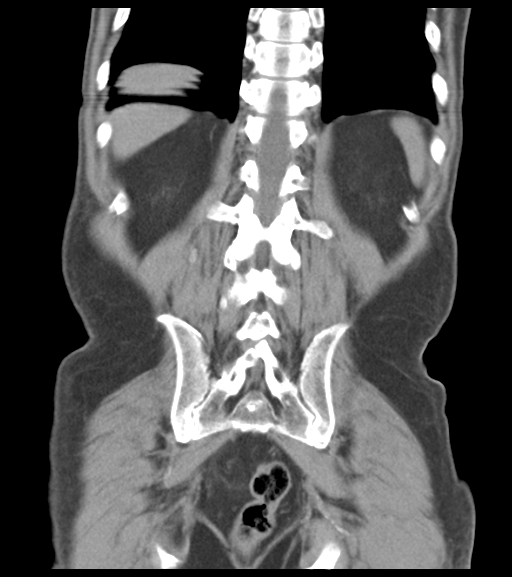 File:Appendiceal abscesses (Radiopaedia 50999-56542 Coronal non-contrast 46).png