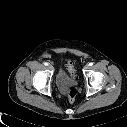 File:Appendiceal adenocarcinoma complicated by retroperitoneal abscess (Radiopaedia 58007-65039 B 131).jpg