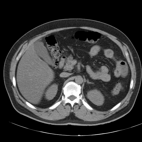 File:Appendicitis and giant appendicolith (Radiopaedia 80251-93588 Axial non-contrast 15).jpg