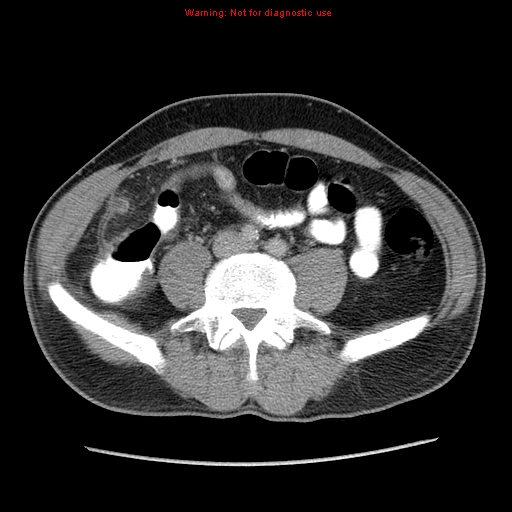 File:Appendicitis and renal cell carcinoma (Radiopaedia 17063-16760 A 37).jpg