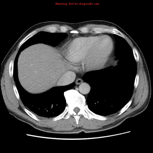 File:Appendicitis and renal cell carcinoma (Radiopaedia 17063-16760 A 4).jpg