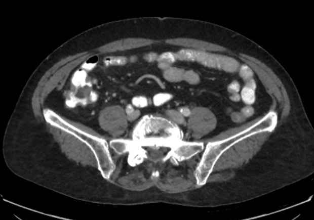 File:Appendicitis due to chicken fibula (Radiopaedia 74314-85198 A 13).jpg