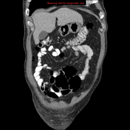File:Appendicitis mass in inguinal hernia (Radiopaedia 26858-27029 B 10).jpg