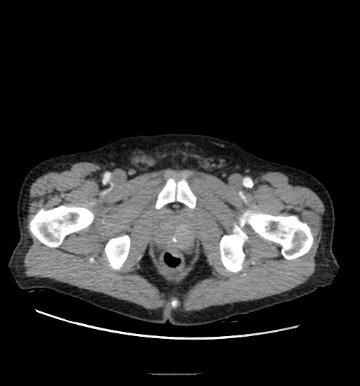 Appendicitis with localized perforation and abscess formation (Radiopaedia 49035-54130 A 87).jpg