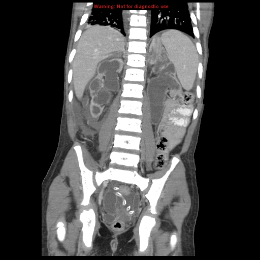Appendicitis with phlegmon (Radiopaedia 9358-10046 B 48).jpg