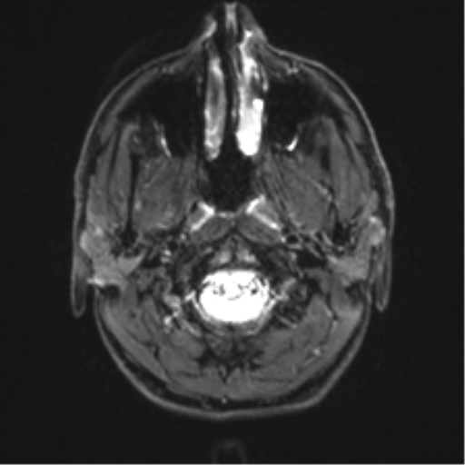 Arachnoid cyst - cerebellopontine angle (Radiopaedia 59689-67083 Axial DWI 1).png