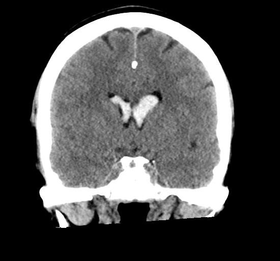 File:Arteriovenous malformation (cerebral) (Radiopaedia 40070-42579 Coronal non-contrast 17).png