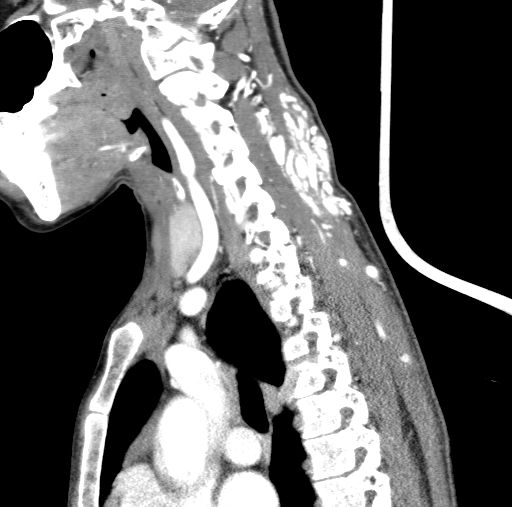 File:Arteriovenous malformation of the neck (Radiopaedia 53935-60062 C 53).jpg