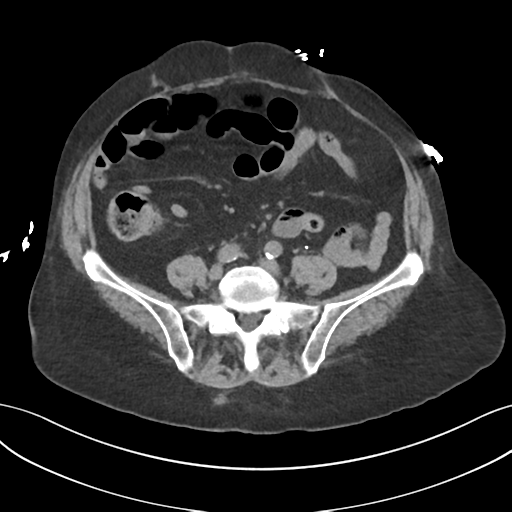 File:Ascending cholangitis (Radiopaedia 39068-41253 Axial non-contrast 42).png