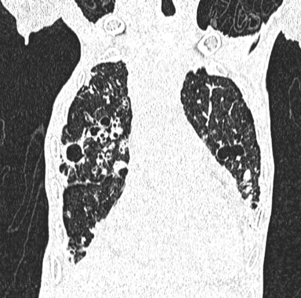 Aspergilloma- with Monod sign (Radiopaedia 44737-48532 Coronal lung window 175).jpg