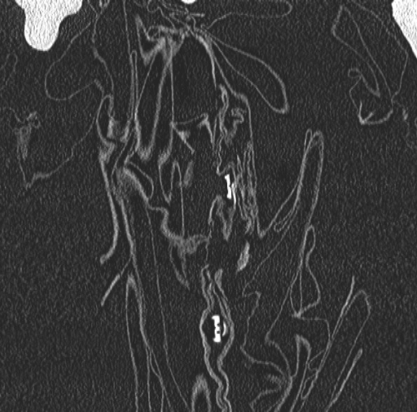 Aspergilloma- with Monod sign (Radiopaedia 44737-48532 Coronal lung window 85).jpg