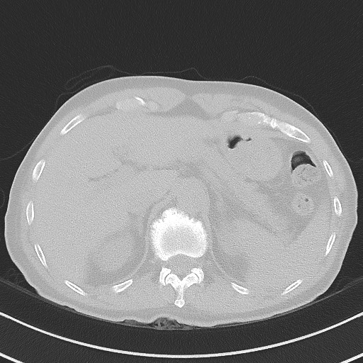 Aspergilloma on background pulmonary fibrosis (Radiopaedia 60942-68757 A 56).jpg