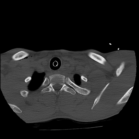 Atlanto-occipital dissociation (Traynelis type 1), C2 teardrop fracture, C6-7 facet joint dislocation (Radiopaedia 87655-104061 Axial bone window 91).jpg