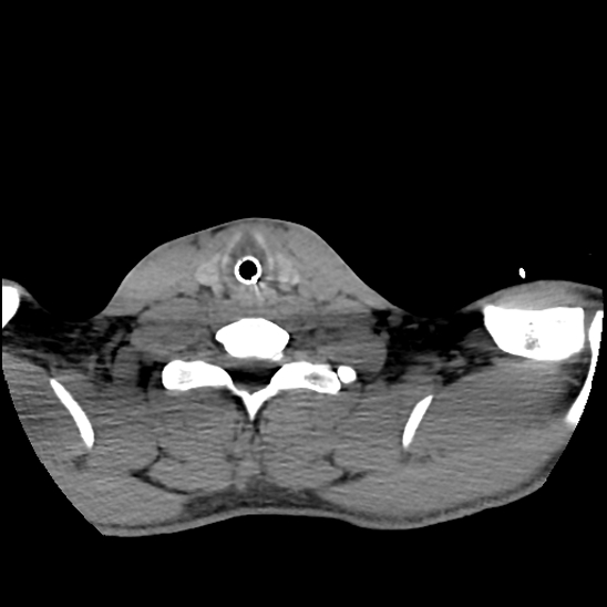 File:Atlanto-occipital dissociation (Traynelis type 1), C2 teardrop fracture, C6-7 facet joint dislocation (Radiopaedia 87655-104061 Axial non-contrast 72).jpg