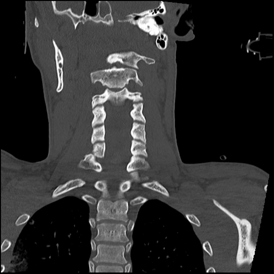 Atlanto-occipital dissociation (Traynelis type 1), C2 teardrop fracture, C6-7 facet joint dislocation (Radiopaedia 87655-104061 Coronal bone window 40).jpg