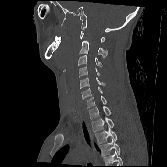 File:Atlanto-occipital dissociation (Traynelis type 1), C2 teardrop fracture, C6-7 facet joint dislocation (Radiopaedia 87655-104061 Sagittal bone window 40).jpg