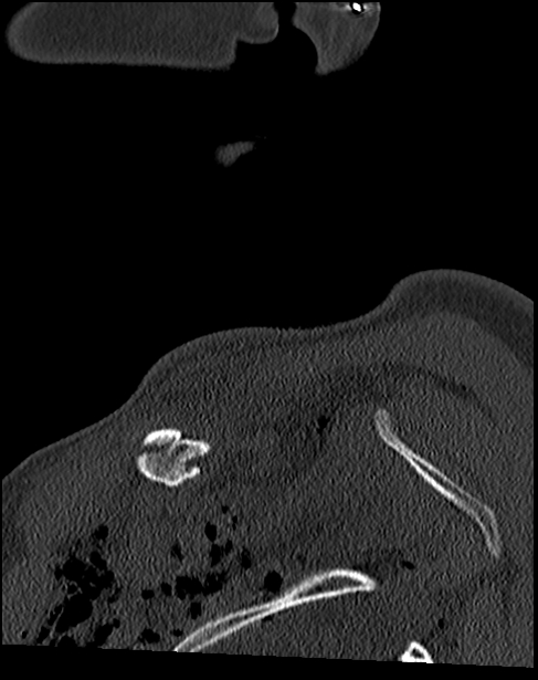 Atlanto-occipital dissociation - Traynelis type 1 (Radiopaedia 87570-103948 Sagittal bone window 5).jpg