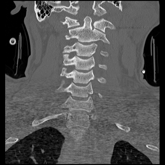 Atlanto-occipital dissociation injury (Radiopaedia 29274-29698 Coronal bone window 26).png