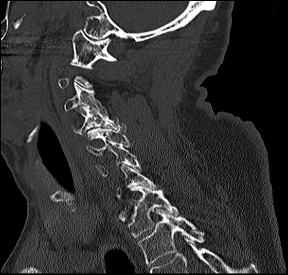 File:Atlas (type 3b subtype 1) and axis (Anderson and D'Alonzo type 3, Roy-Camille type 2) fractures (Radiopaedia 88043-104607 Sagittal bone window 33).jpg