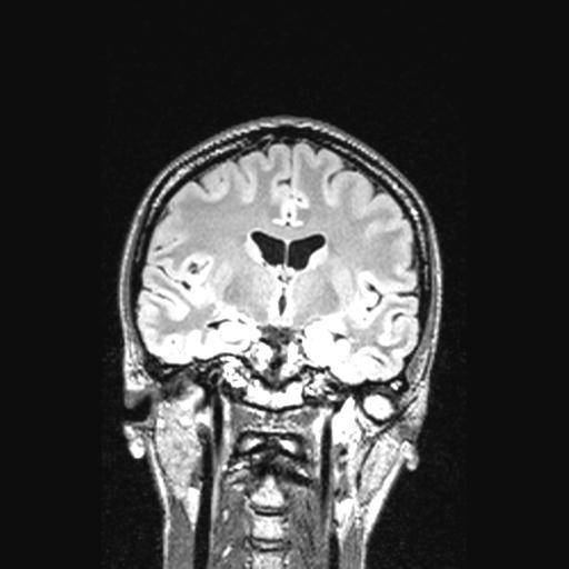 Atretic encephalocoele with inferior vermis hypoplasia (Radiopaedia 30443-31108 Coronal FLAIR 100).jpg