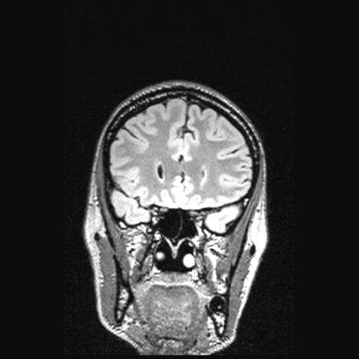 Atretic encephalocoele with inferior vermis hypoplasia (Radiopaedia 30443-31108 Coronal FLAIR 131).jpg