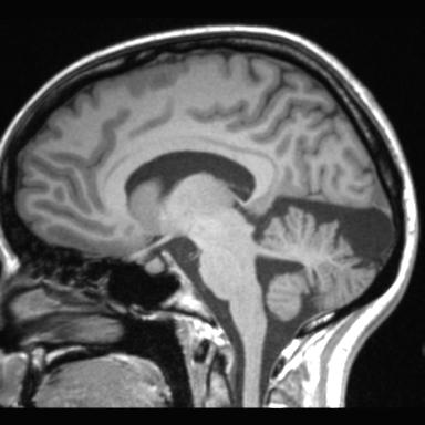 File:Atretic encephalocoele with inferior vermis hypoplasia (Radiopaedia 30443-31108 Sagittal T1 72).jpg