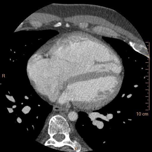 File:Atrial septal defect (upper sinus venosus type) with partial anomalous pulmonary venous return into superior vena cava (Radiopaedia 73228-83961 A 168).jpg