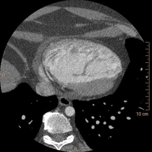 Atrial septal defect (upper sinus venosus type) with partial anomalous pulmonary venous return into superior vena cava (Radiopaedia 73228-83961 A 222).jpg