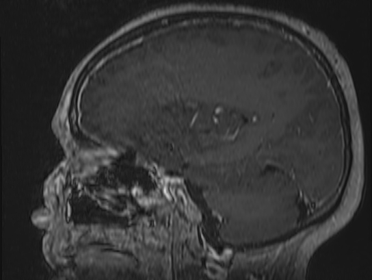 Atypical meningioma (Radiopaedia 62985-71406 Sagittal T1 C+ 57).jpg