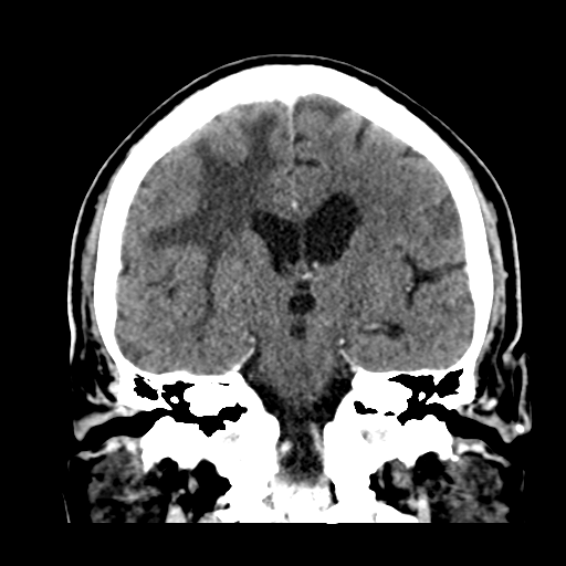 Atypical meningioma (WHO grade II) with brain invasion (Radiopaedia 57767-64728 Coronal C+ 34).png