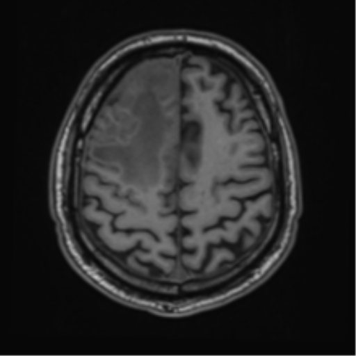 File:Atypical meningioma (WHO grade II) with brain invasion (Radiopaedia 57767-64729 Axial T1 40).png