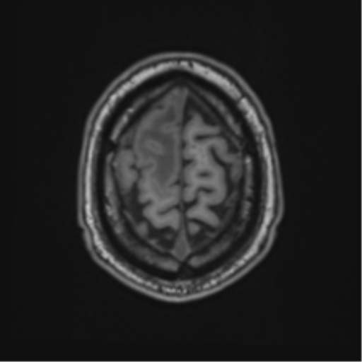 File:Atypical meningioma (WHO grade II) with brain invasion (Radiopaedia 57767-64729 Axial T1 46).png
